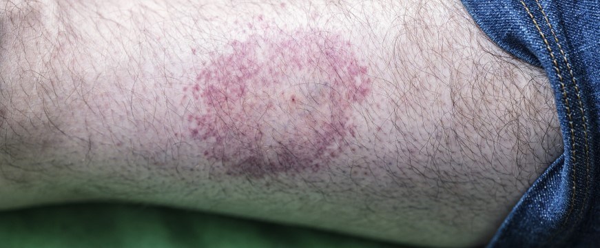 A circular rash on someone's arm