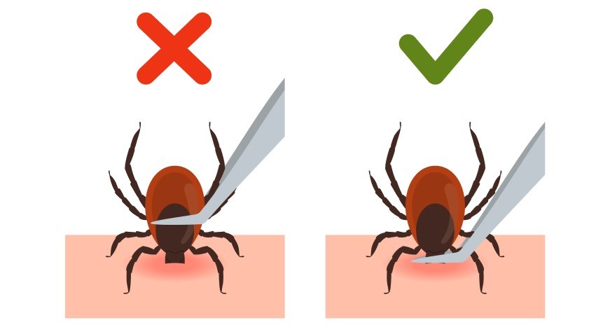 Diagram showing the proper way to remove a tick from skin using tweezers. You should remove the tick where it has attached to the skin rather than by pulling it off by the body